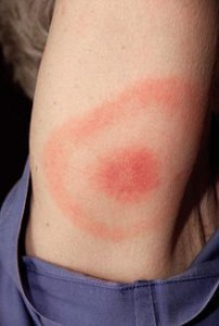 signs-and-symptoms-of-lyme-disease