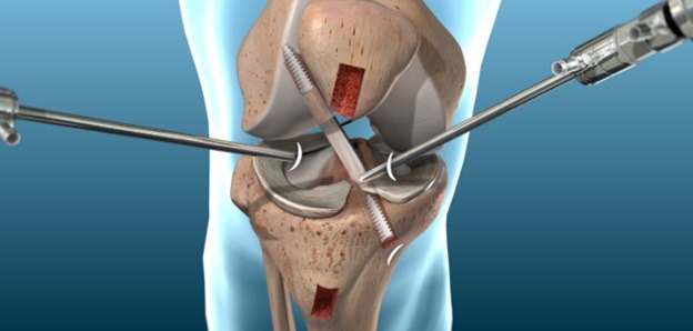 What You Need to Know about Acl Reconstruction in Singapore
