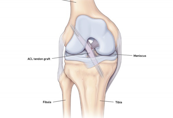 Who can benefit from Acl Reconstruction