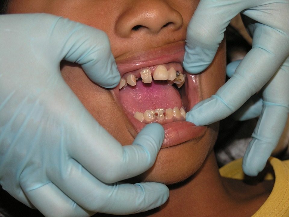 young patient with decaying teeth